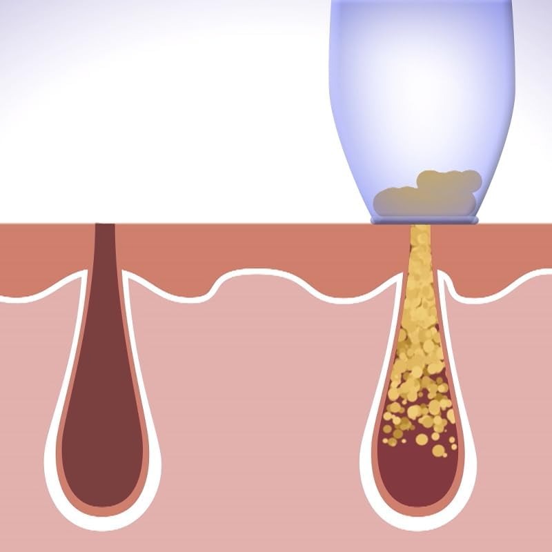 Pore Cleaning Device