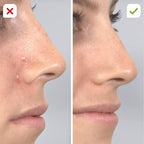 Pore Cleaning Device
