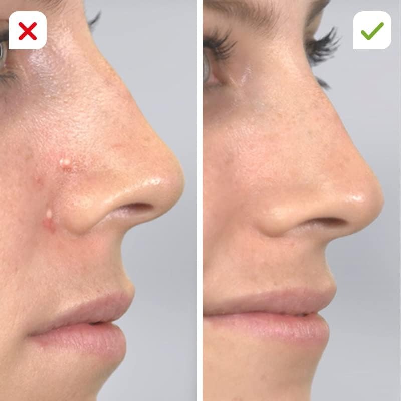 Pore Cleaning Device
